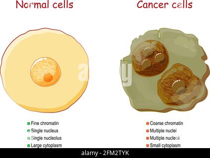 Cancer et cellules normales. Comparaison et différence entre les tissus sains et la tumeur. Détails sur la chromatine, le noyau et le cytoplasme. Vecteur Illustration de Vecteur