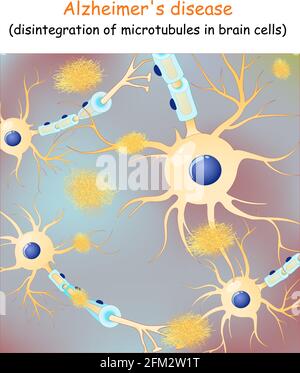 Maladie d'Alzheimer. Démence. Arrière-plan vectoriel avec les neurones et les plaques amyloïdes (protéine tau qui conduit à la désintégration des microtubules du cerveau Illustration de Vecteur