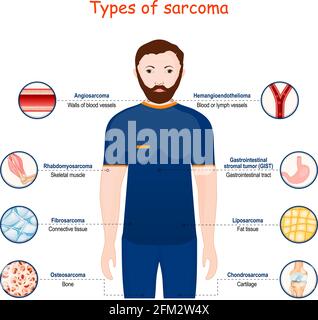sarcome. Types de tumeur maligne. Cancer qui provient de cellules transformées de connective, d'os, de cartilage, de graisse et de tissu vasculaire. Vecteur Illustration de Vecteur