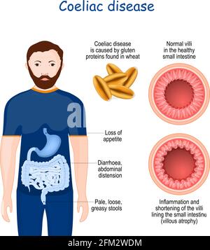 La maladie cœliaque est une maladie auto-immune qui affecte l'intestin grêle. Signes et symptômes de la maladie cœliaque. Coupe transversale de l'intestin grêle avec NOR Illustration de Vecteur