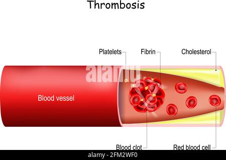 Thrombose. Caillot de sang dans un vaisseau sanguin (artère ou veine). Problème de santé. Illustration vectorielle à usage médical. Illustration de Vecteur