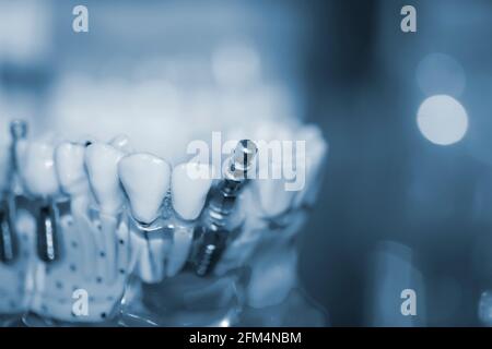 Modèle transparent de dents humaines avec implants en gros plan. Banque D'Images