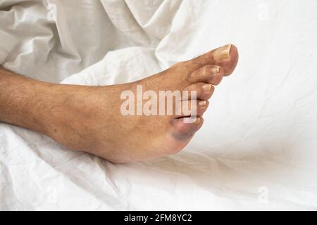 Ecchymose le pied du pied. Gros plan sur le petit orteil cassé d'un homme âgé montrant une décoloration. Banque D'Images