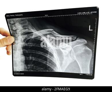 Clavicule gauche cassé. Fracture de clavicule. Autorisation du modèle et de la propriété de radiographie de l'hôpital. Banque D'Images