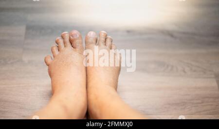 Les pieds de l'homme vieux rider la peau enflée les pieds avec le cancer et le corps manque de la protéine pour la santé donc pas bon. Banque D'Images