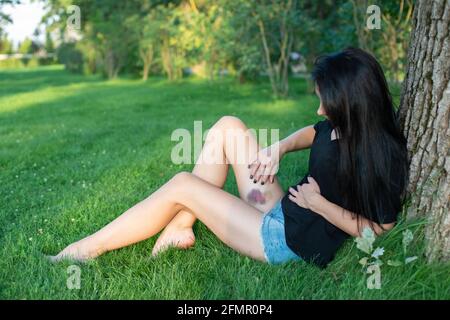 Une jeune femme avec une grosse contusion pourpre sur sa jambe est assise sur l'herbe dans le parc. Hématome post-traumatique. Concept de violence domestique. Sélection douce Banque D'Images