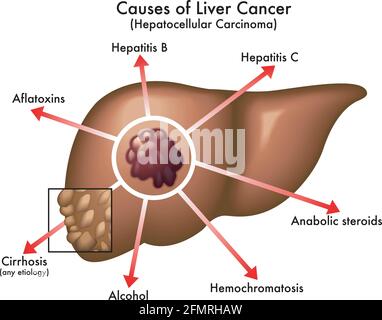 Illustration médicale des principales causes de cancer du foie, avec annotations, sur fond blanc. Illustration de Vecteur