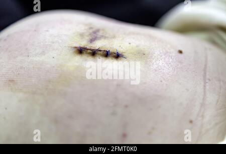 Détail de l'opération médicale, points de suture pour la guérison, post-opératoire Banque D'Images
