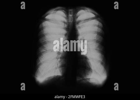 Film radiographique du thorax humain. Radiographie des poumons des personnes. Image en noir et blanc Banque D'Images