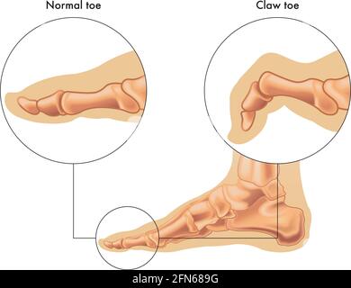 L'illustration médicale montre la différence entre un orteil normal et un orteil à griffe, avec des annotations. Illustration de Vecteur