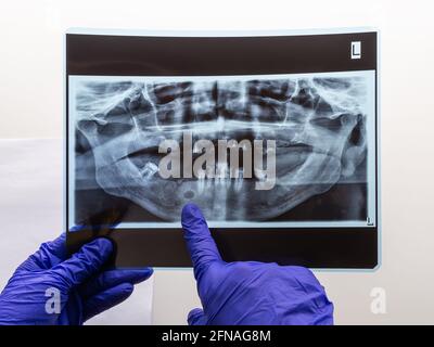 La main du dentiste montre la zone problématique dans l'os de la mâchoire inférieure sur une radiographie panoramique d'une personne âgée avec seulement quelques dents dans sa bouche. Radiographie d'origine Banque D'Images