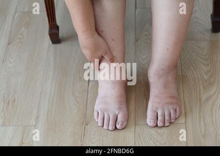 Femme âgée enflée les pieds et la jambe Banque D'Images