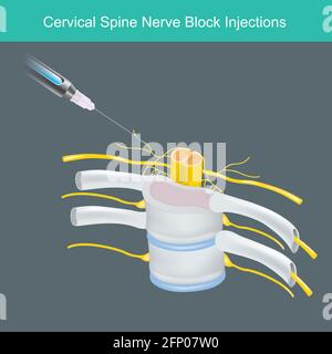 Injections du bloc nerveux du rachis cervical. Illustration pour l'apprentissage de la solution anesthésique injecté le nerf cervical de colonne cervicale de cou humain. Illustration de Vecteur