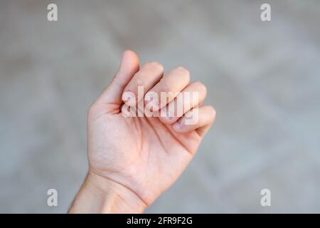 Main d'un homme avec des ongles mordus et laids. Mauvais soin des mains Banque D'Images