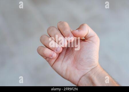 Main d'un homme avec des ongles mordus et laids. Mauvais soin des mains Banque D'Images