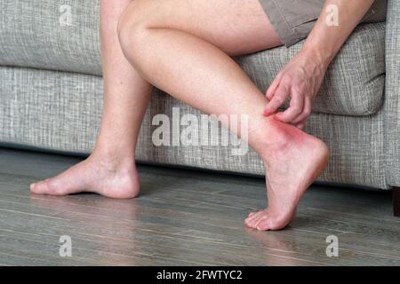 Gale sur la peau. Une femme raye une zone enflammée sur sa jambe. Lichen sur la jambe sur fond rouge Banque D'Images