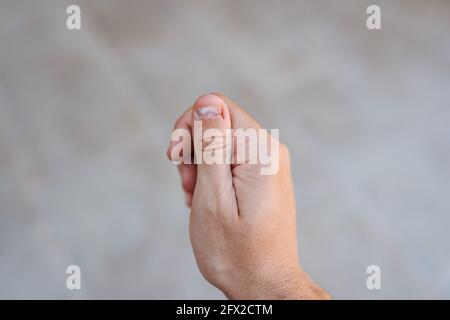 Gros plan d'une main droite montrant un pouce avec un ongle blanc et mordu et une plaie avec du sang Banque D'Images