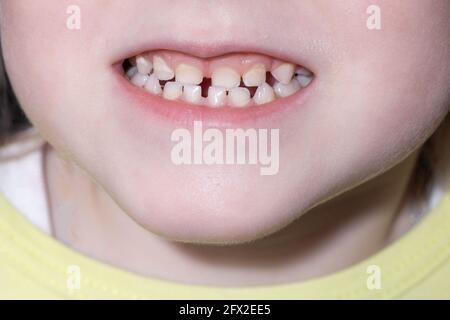 petite fille à bouche ouverte et dents de bébé. Le concept de soins appropriés pour la cavité buccale et les dents de bébé chez les enfants, gros plan. Dentiste Banque D'Images