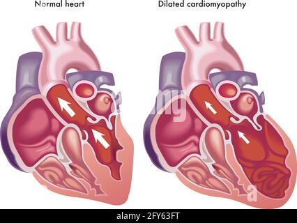 Illustration médicale des effets de la cardiomyopathie dilatée. Illustration de Vecteur