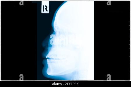 Film radiographique du crâne et du rachis cervical vue latérale, film radiographique des os humains du nez à la poitrine. Banque D'Images