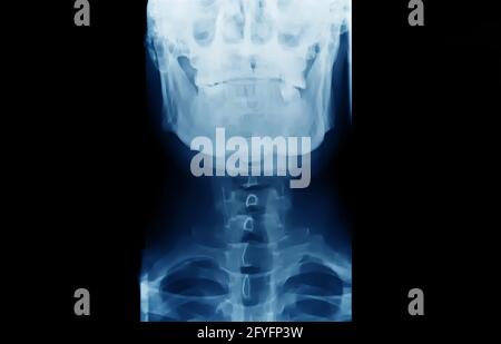 Film radiographique du crâne et du rachis cervical vue latérale, film radiographique des os humains du nez à la poitrine. Banque D'Images