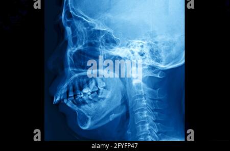 Film radiographique du crâne et du rachis cervical vue latérale, film radiographique des os humains du nez à la poitrine. Banque D'Images