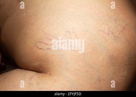 Varices sur une jambe chez les femmes âgées, gros plan et gros plan, mise au point sélective, partie asiatique de peau corporelle, concept de santé Banque D'Images