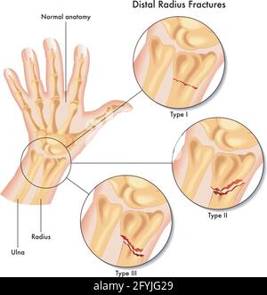 Illustration médicale des différents types de fracture du rayon distal. Illustration de Vecteur