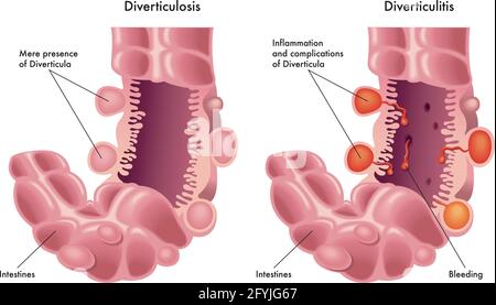 Illustration médicale de la différence entre la diverticulose et la diverticulite. Illustration de Vecteur