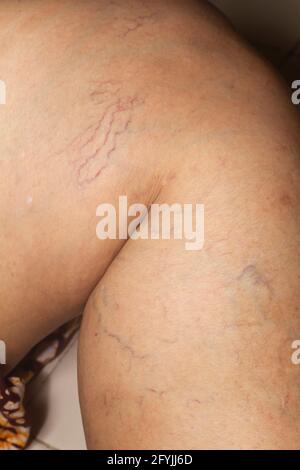 Varices sur une jambe chez les femmes âgées, gros plan et gros plan, mise au point sélective, partie asiatique de peau corporelle, concept de santé Banque D'Images