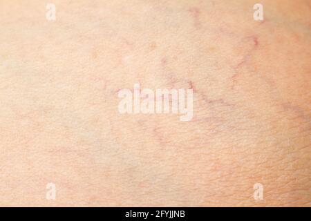 Varices sur une jambe chez les femmes âgées, gros plan et gros plan, mise au point sélective, partie asiatique de peau corporelle, concept de santé Banque D'Images