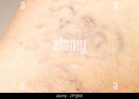 Varices sur une jambe chez les femmes âgées, gros plan et gros plan, mise au point sélective, partie asiatique de peau corporelle, concept de santé Banque D'Images