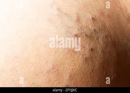 Varices sur une jambe chez les femmes âgées, gros plan et gros plan, mise au point sélective, partie asiatique de peau corporelle, concept de santé Banque D'Images