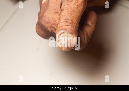 Infection fongique sur les ongles du pouce de la vieille femme. Banque D'Images