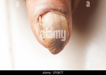 Infection fongique sur les ongles du pouce de la vieille femme. Banque D'Images