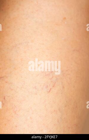 Varices sur une jambe chez les femmes âgées, gros plan et gros plan, mise au point sélective, partie asiatique de peau corporelle, concept de santé Banque D'Images