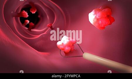 Retrait d'un polype colique, illustration Banque D'Images