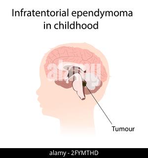 Ependymoma intrasensoriel dans l'enfance, illustration Banque D'Images