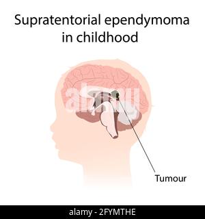 Ependymoma supratentorial dans l'enfance, illustration Banque D'Images