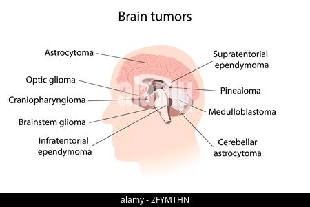 Tumeur cérébrale avec explications, illustration Banque D'Images