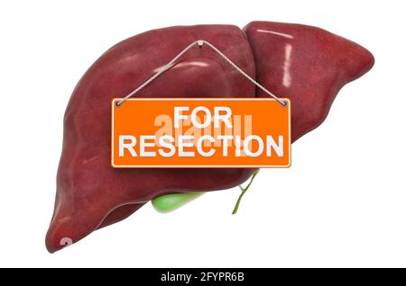 Concept de résection du foie. Foie humain avec pour le signe de suspension de résection, rendu 3D isolé sur fond blanc Banque D'Images