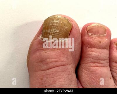 Champignon de l'ongle de l'ongle du pied - gros orteil d'une personne souffrant d'Onychomycose, une infection fongique causant le jaunissement et l'épaississement de l'ongle du pied. Banque D'Images