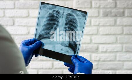Rayons X des poumons humains. Le médecin diagnostique le patient. Radiographie thoracique. Banque D'Images
