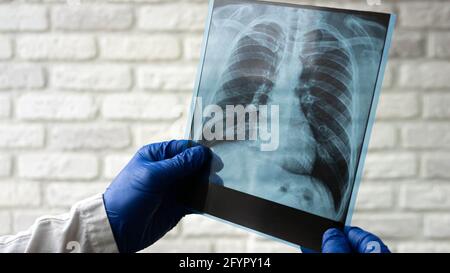 Rayons X des poumons humains. Le médecin diagnostique le patient. Radiographie thoracique. Banque D'Images