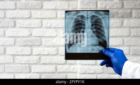 Rayons X des poumons humains. Le médecin diagnostique le patient. Radiographie thoracique. Banque D'Images