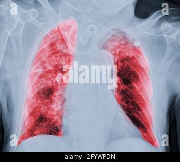 Radiographie thoracique ou radiographie image du thorax ou du poumon humain ( zone rouge ) montrant la tuberculose tuberculose tuberculose tuberculose (TB) et le virus corona 2019. Banque D'Images