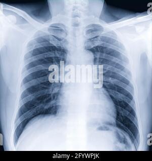 Radiographie thoracique ou radiographie du thorax humain pour un diagnostic médical. Vérifier concept. Banque D'Images