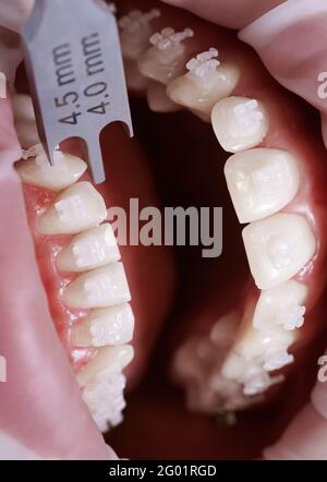Gros plan de l'orthodontiste à l'aide d'une jauge de support en aluminium tout en fixant les bretelles aux dents du patient. Personne avec des supports sur les dents ayant une procédure dentaire. Concept de la dentisterie et du traitement orthodontique. Banque D'Images