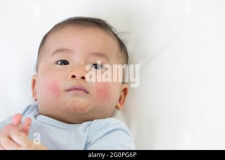 Les éruptions cutanées chez les bébés concept Banque D'Images