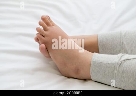 Femmes enceintes avec des pieds gonflées, pied de douleur et allongé sur le lit dans la chambre. Gonflement des pieds et intoxication foetale ou concept de toxicité Banque D'Images
